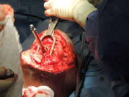 A screw anchored intramedullary hip stem